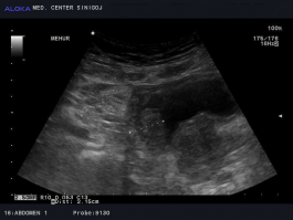 Ultrazvok mehurja - tumor mehurja, infiltrira v področje prostate